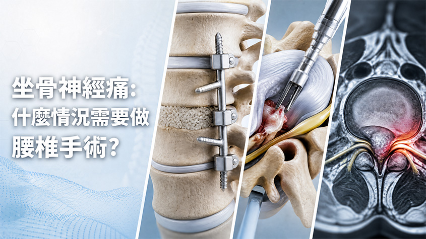 坐骨神經痛: 什麼情況需要做腰椎手術?